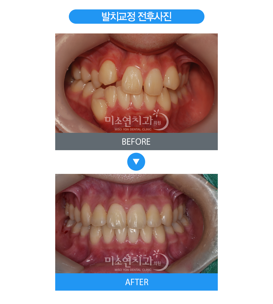 미소연치과 치료 전후사진-1