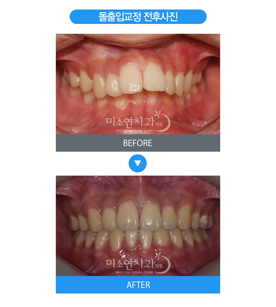 미소연치과 치료 전후사진-2