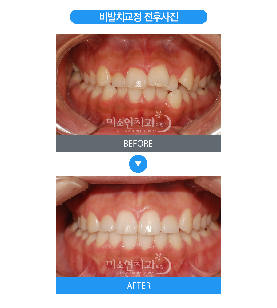미소연치과 치료 전후사진-3