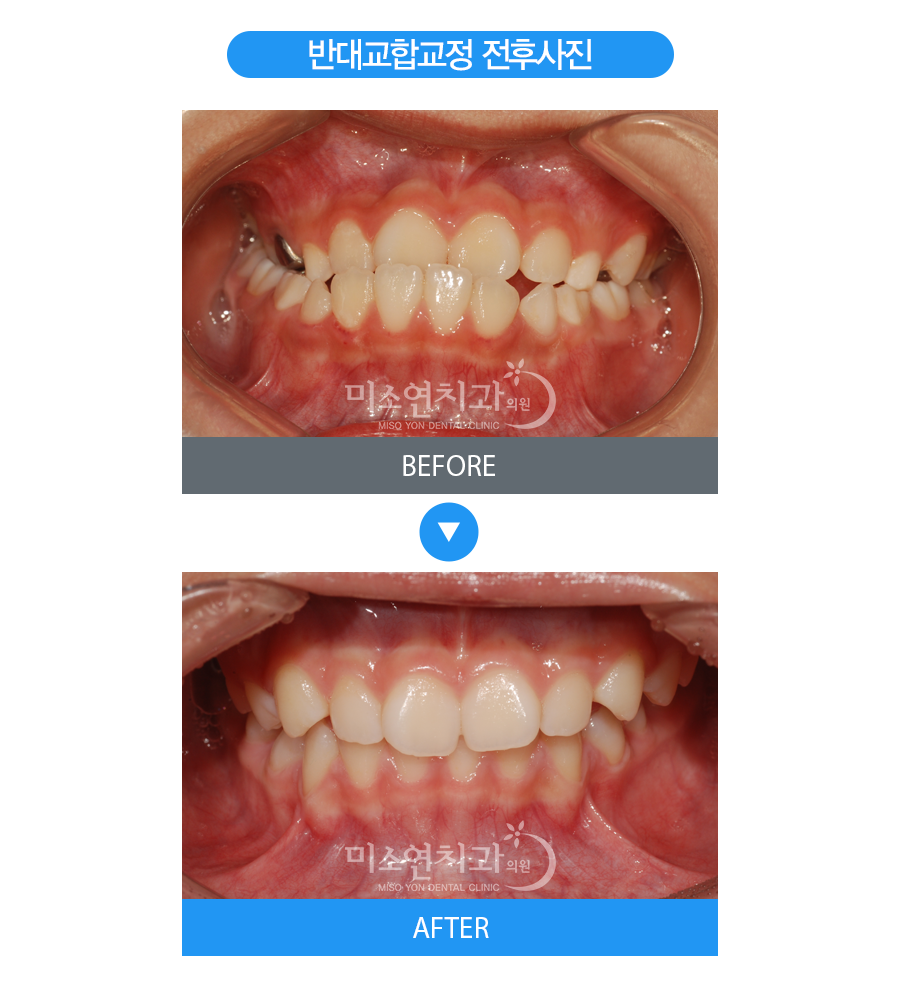 미소연치과 치료 전후사진-4