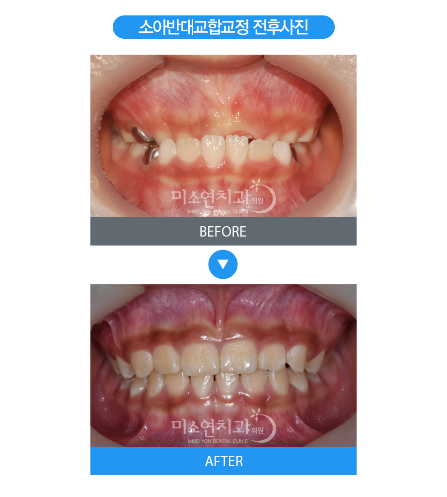 미소연치과 치료 전후사진-5
