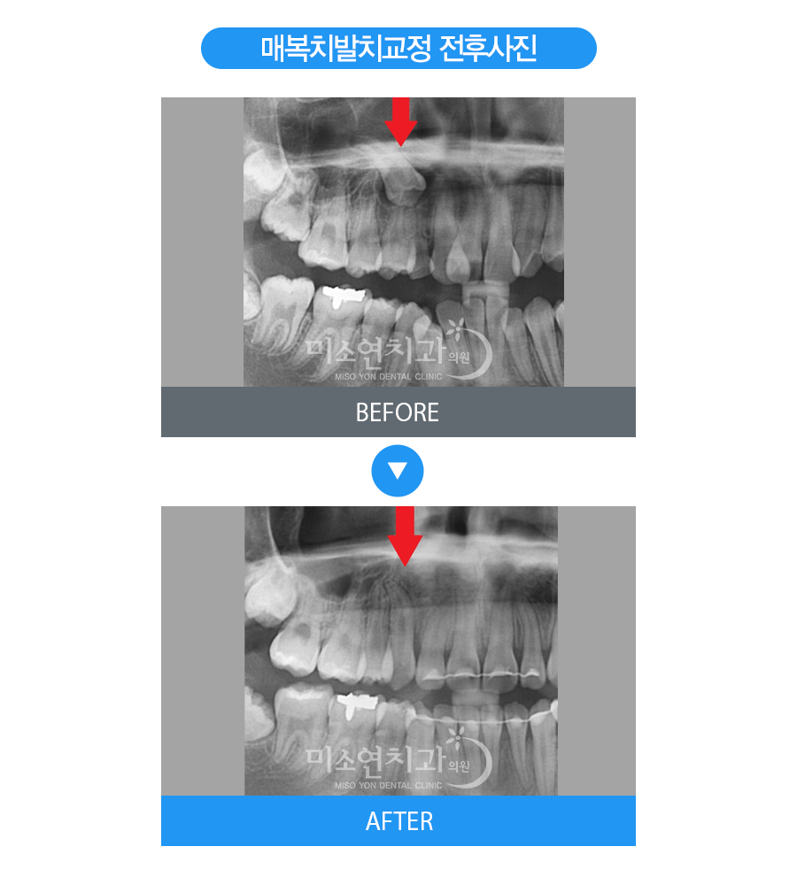 미소연치과 치료 전후사진-6