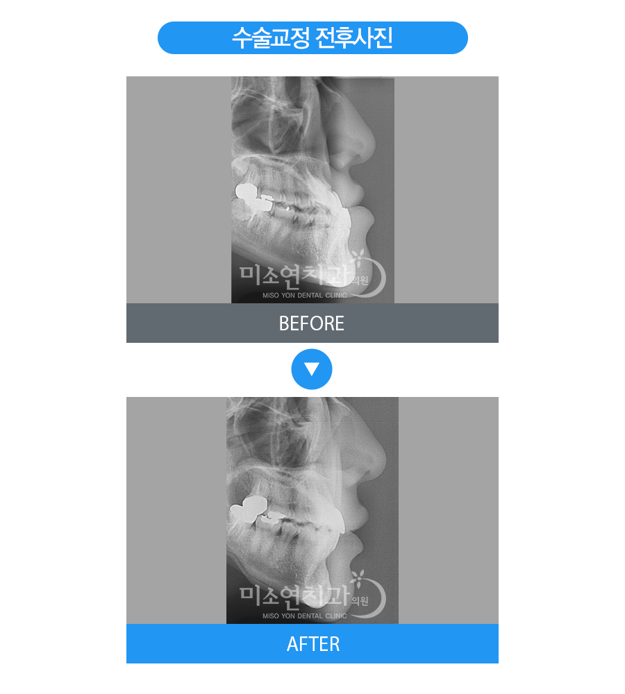 미소연치과 치료 전후사진-7
