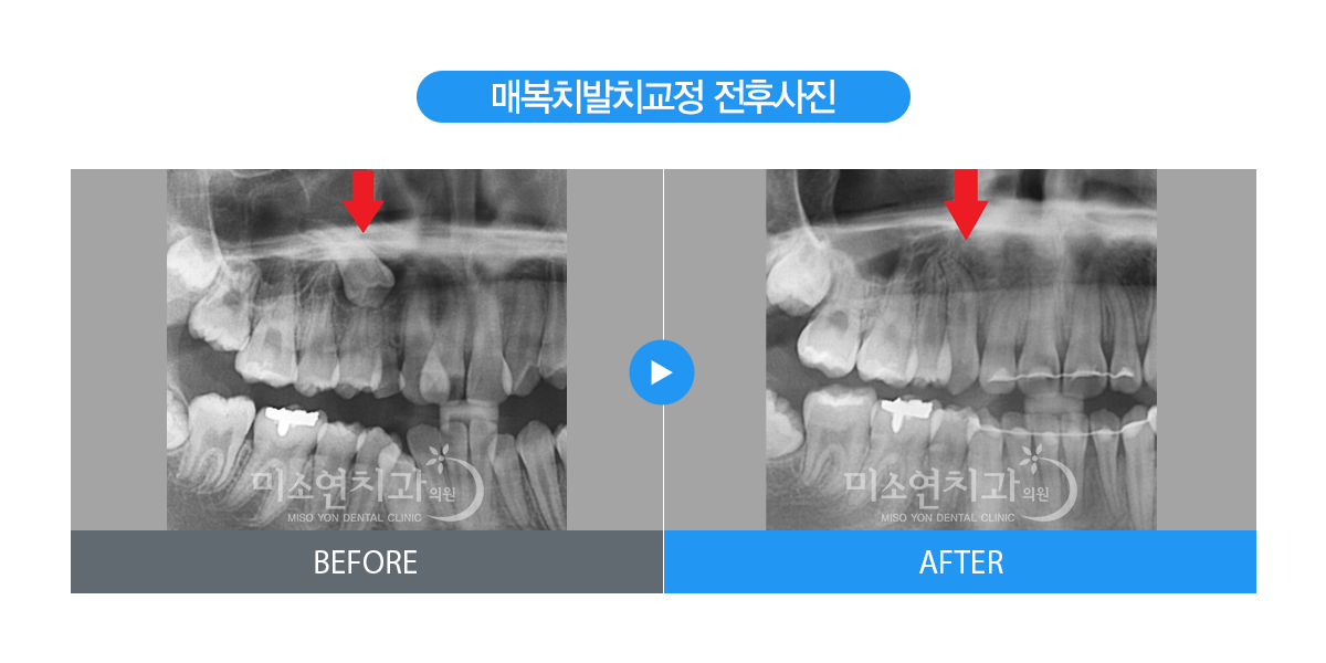 미소연치과 치료 전후사진-6