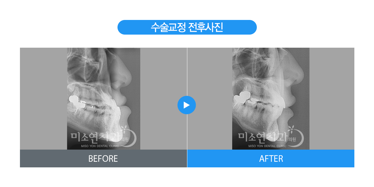 미소연치과 치료 전후사진-7