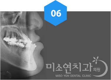 안정적인 악교정수술을 위한 수술교정